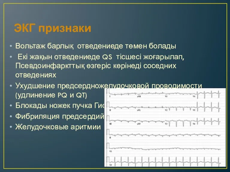 ЭКГ признаки Вольтаж барлық отведениеде төмен болады Екі жақын отведениеде