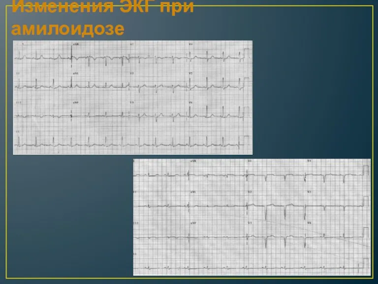 Изменения ЭКГ при амилоидозе