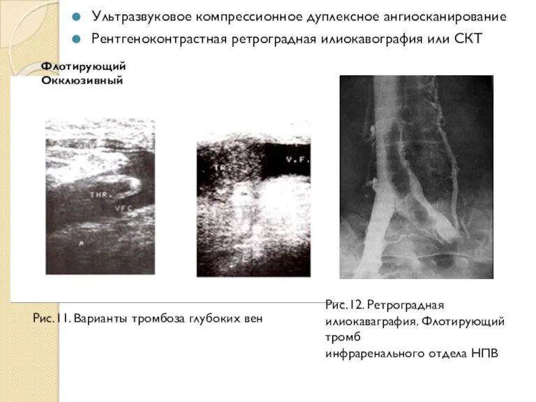 Ультразвуковое компрессионное дуплексное ангиосканирование Рентгеноконтрастная ретроградная илиокавография или СКТ Рис.11. Варианты тромбоза глубоких