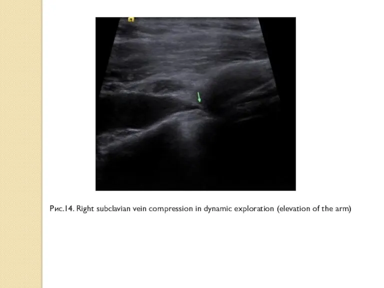 Рис.14. Right subclavian vein compression in dynamic exploration (elevation of the arm)