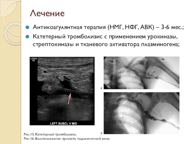 Лечение Антикоагулянтная терапия (НМГ, НФГ, АВК) – 3-6 мес.; Катетерный тромболизис с применением