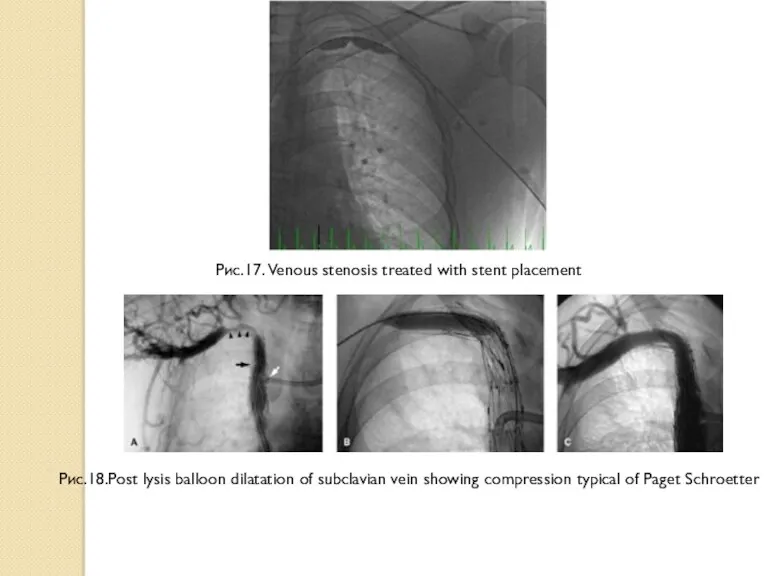 Рис.17. Venous stenosis treated with stent placement Рис.18.Post lysis balloon dilatation of subclavian