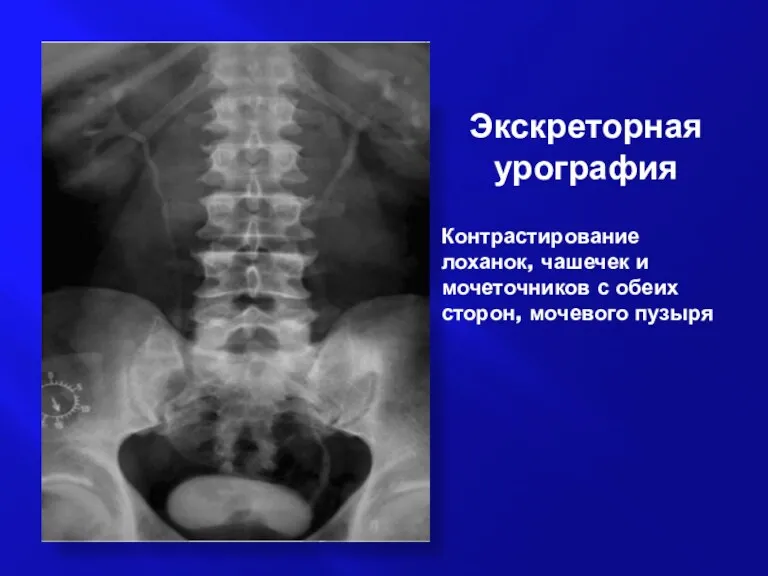 Экскреторная урография Контрастирование лоханок, чашечек и мочеточников с обеих сторон, мочевого пузыря