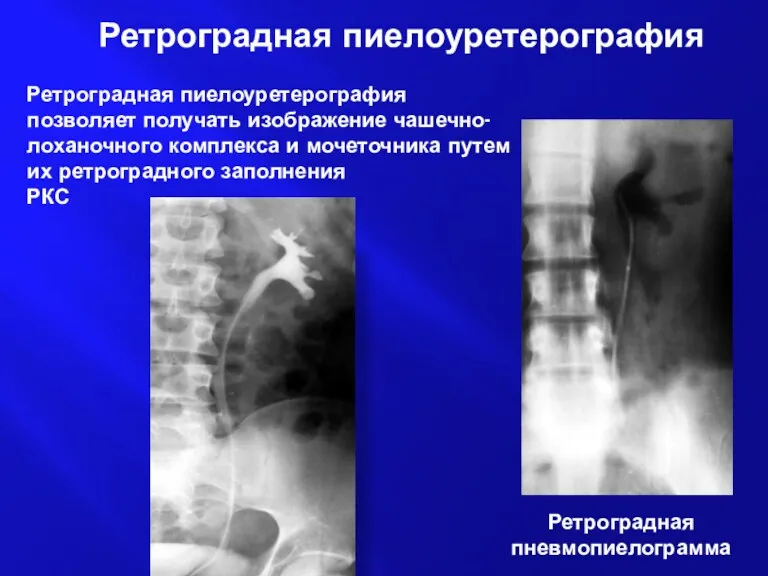 Ретроградная пиелоуретерография Ретроградная пиелоуретерография позволяет получать изображение чашечно-лоханочного комплекса и