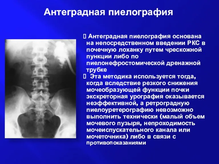 Антеградная пиелография Антеградная пиелография основана на непосредственном введении РКС в