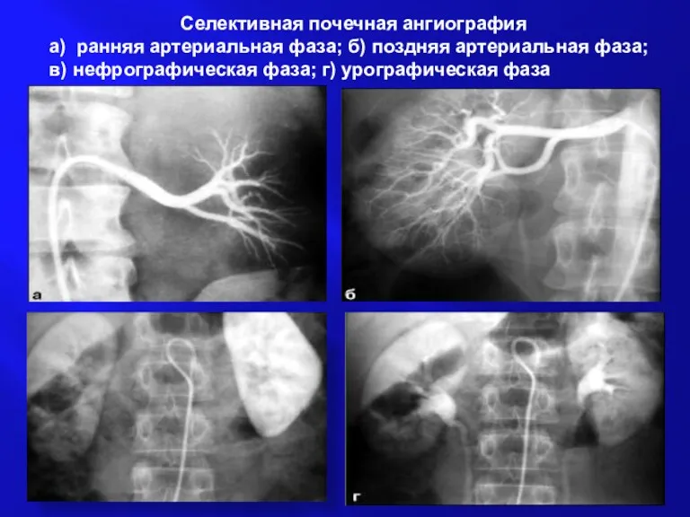 Селективная почечная ангиография а) ранняя артериальная фаза; б) поздняя артериальная