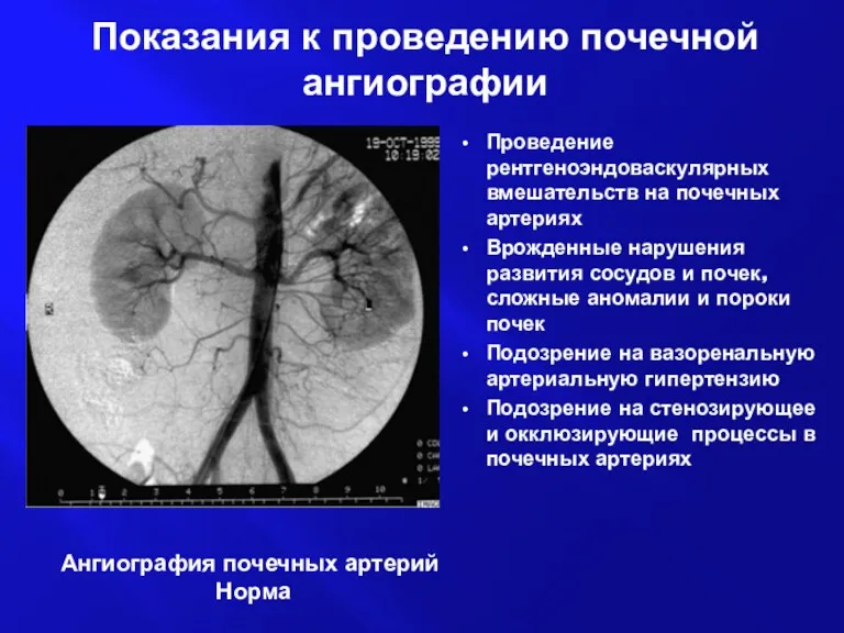 Показания к проведению почечной ангиографии Проведение рентгеноэндоваскулярных вмешательств на почечных