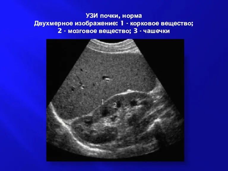 УЗИ почки, норма Двухмерное изображение: 1 - корковое вещество; 2 - мозговое вещество; 3 - чашечки