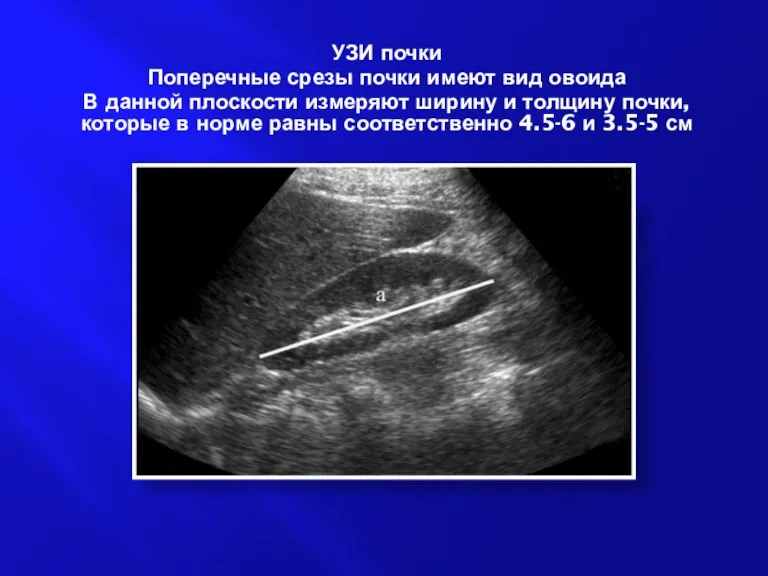 УЗИ почки Поперечные срезы почки имеют вид овоида В данной