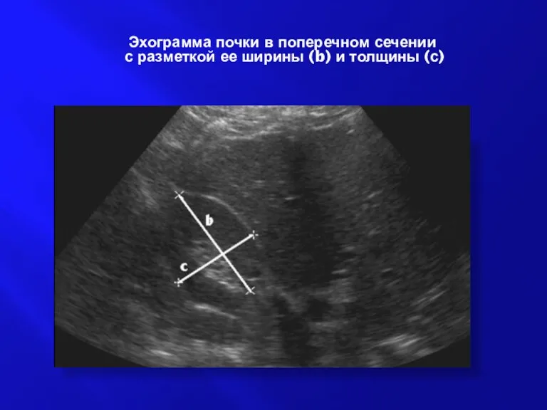 Эхограмма почки в поперечном сечении с разметкой ее ширины (b) и толщины (с)