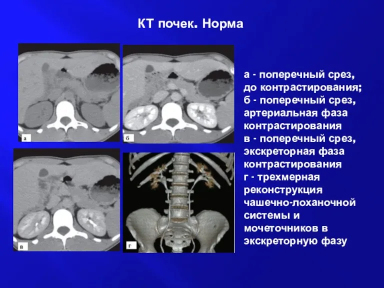 КТ почек. Норма а - поперечный срез, до контрастирования; б