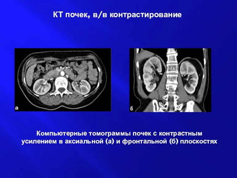 Компьютерные томограммы почек с контрастным усилением в аксиальной (а) и