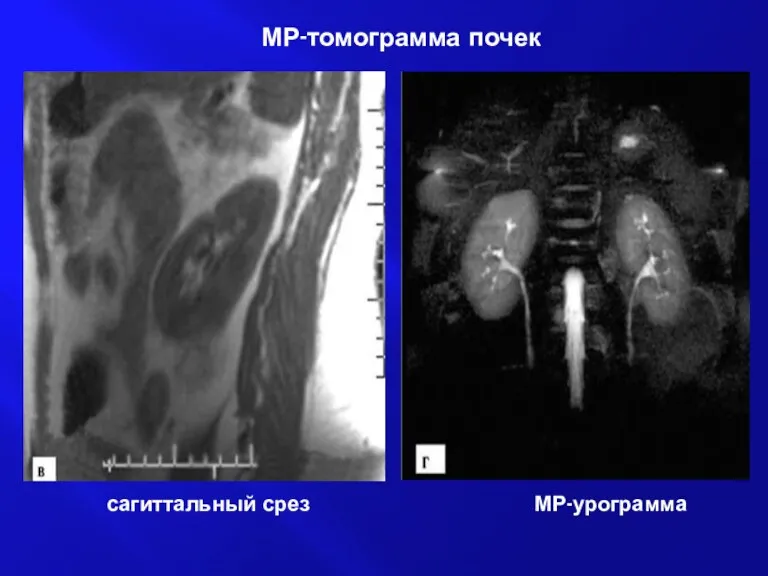 сагиттальный срез МР-урограмма МР-томограмма почек