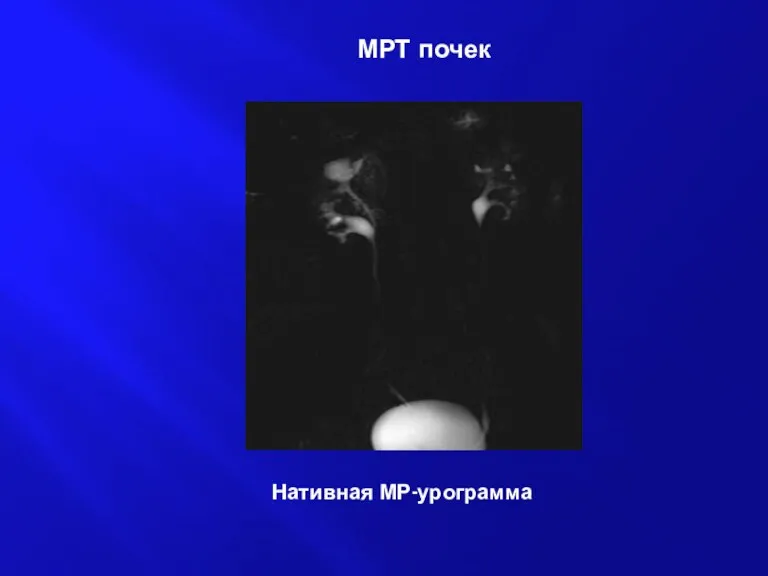 Нативная МР-урограмма МРТ почек