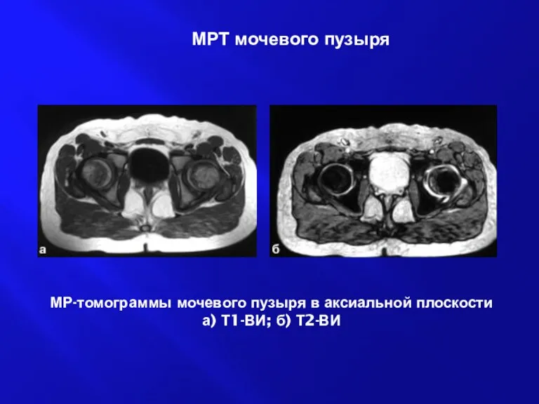 МР-томограммы мочевого пузыря в аксиальной плоскости а) Т1-ВИ; б) Т2-ВИ МРТ мочевого пузыря