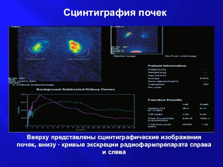 Вверху представлены сцинтиграфические изображения почек, внизу - кривые экскреции радиофармпрепарата справа и слева Сцинтиграфия почек