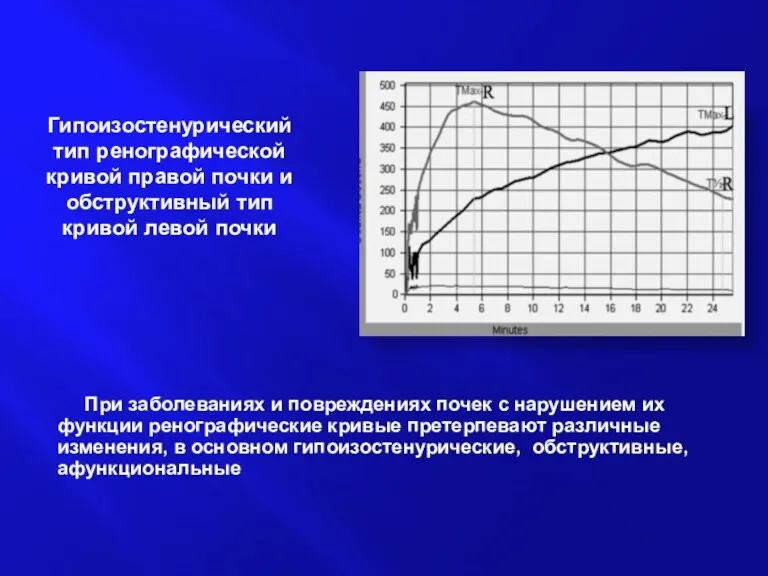 Гипоизостенурический тип ренографической кривой правой почки и обструктивный тип кривой