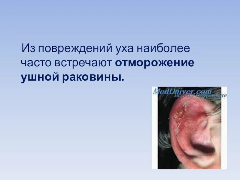 Из повреждений уха наиболее часто встречают отморожение ушной раковины.
