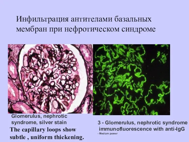 Инфильтрация антителами базальных мембран при нефротическом синдроме 3 - Glomerulus,