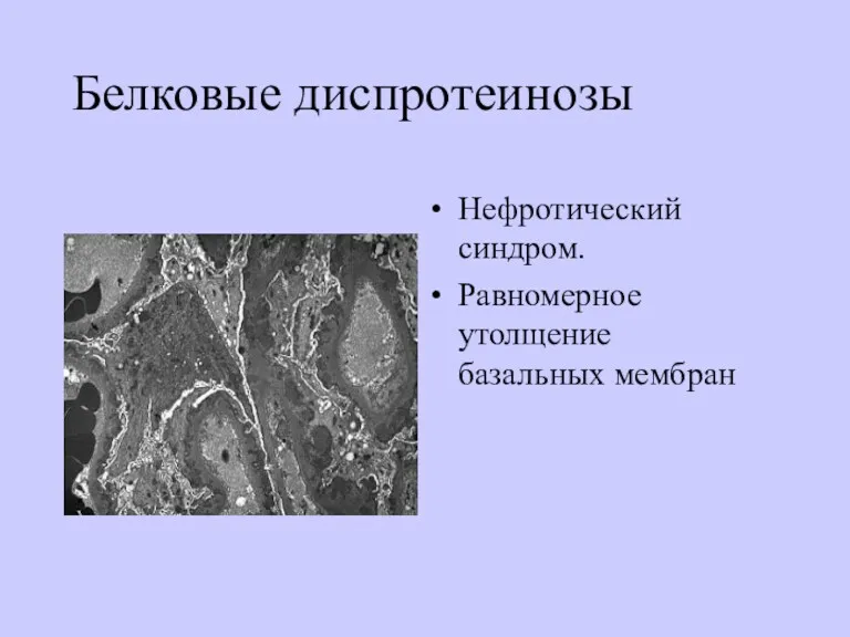 Белковые диспротеинозы Нефротический синдром. Равномерное утолщение базальных мембран