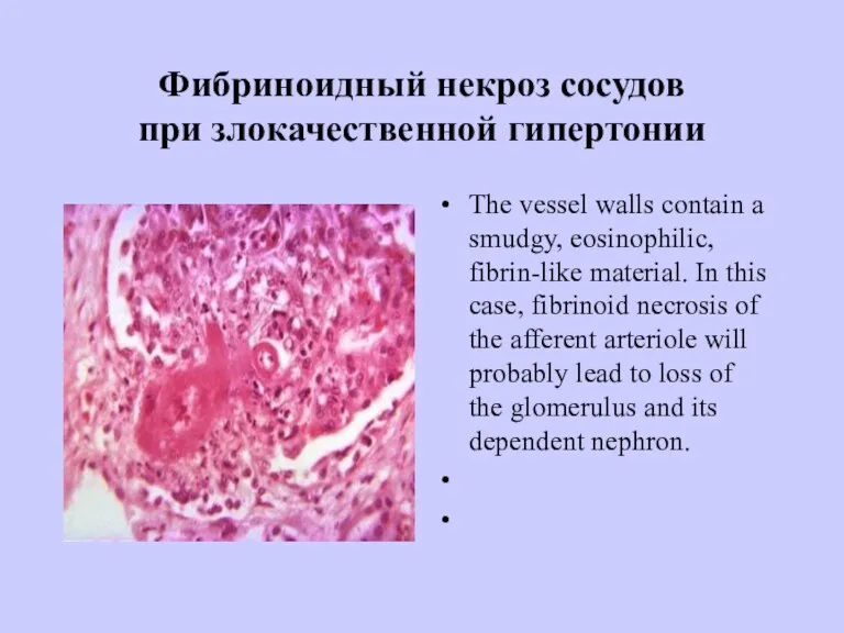 Фибриноидный некроз сосудов при злокачественной гипертонии The vessel walls contain