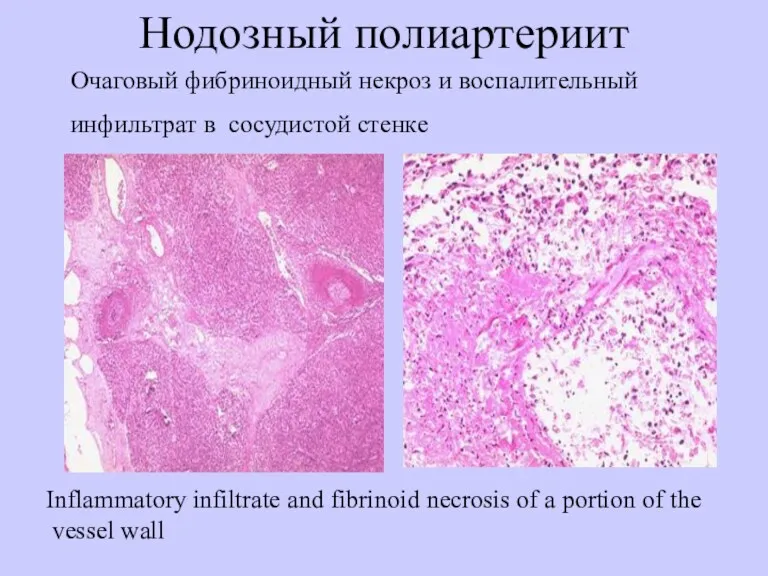 Нодозный полиартериит Очаговый фибриноидный некроз и воспалительный инфильтрат в сосудистой