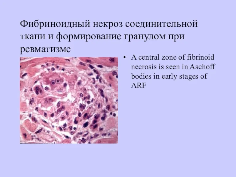 Фибриноидный некроз соединительной ткани и формирование гранулом при ревматизме A