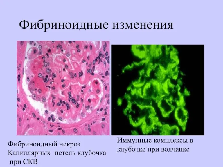 Фибриноидные изменения Фибриноидный некроз Капиллярных петель клубочка при СКВ Иммунные комплексы в клубочке при волчанке