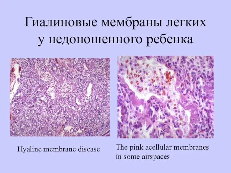 Нyaline membrane disease Тhe pink acellular membranes in some airspaces Гиалиновые мембраны легких у недоношенного ребенка