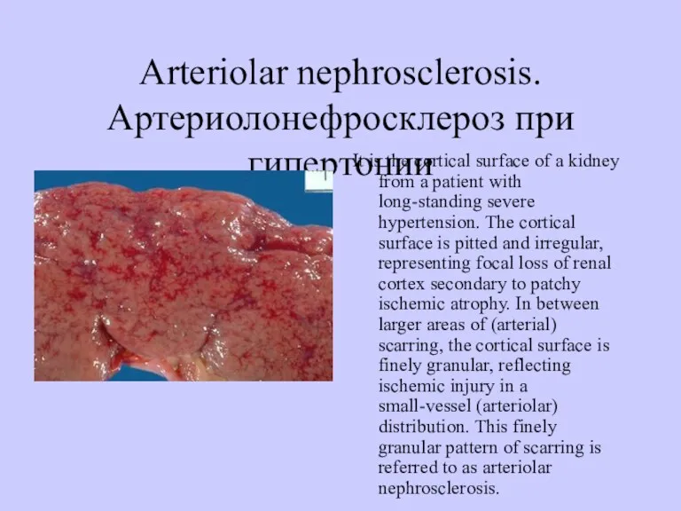 Аrteriolar nephrosclerosis. Артериолонефросклероз при гипертонии It is the cortical surface