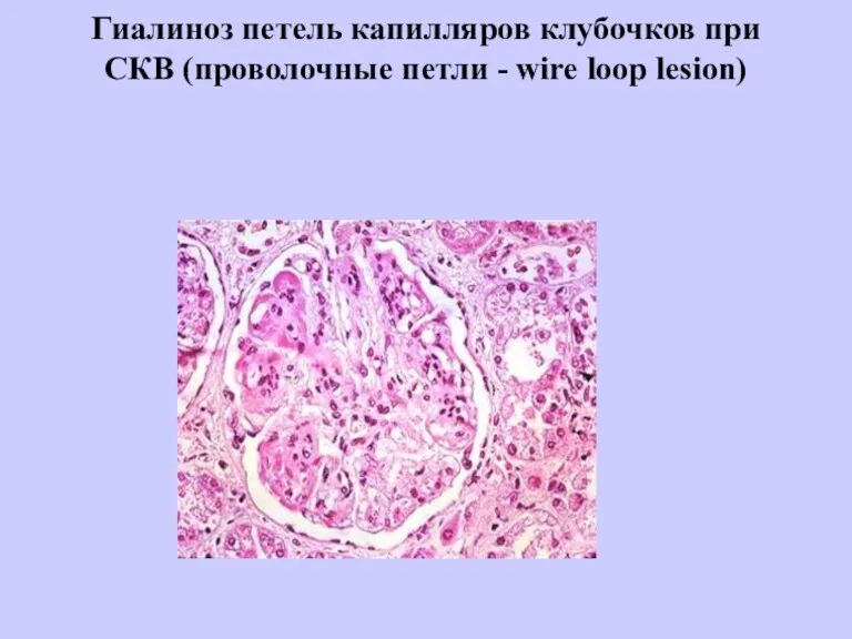 Гиалиноз петель капилляров клубочков при СКВ (проволочные петли - wire loop lesion)