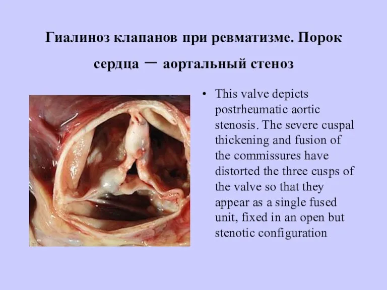 Гиалиноз клапанов при ревматизме. Порок сердца – аортальный стеноз This