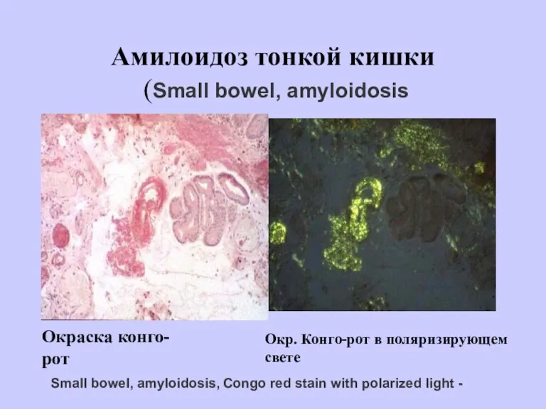 Амилоидоз тонкой кишки (Small bowel, amyloidosis Окраска конго-рот Окр. Конго-рот