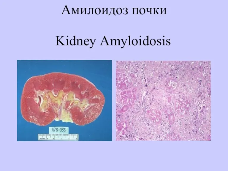 Амилоидоз почки Kidney Аmyloidosis