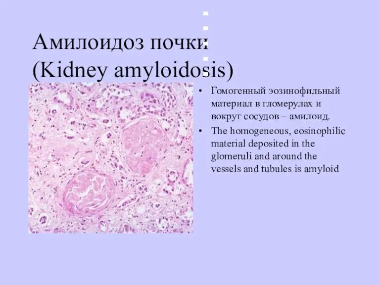 Амилоидоз почки (Kidney amyloidosis) Гомогенный эозинофильный материал в гломерулах и