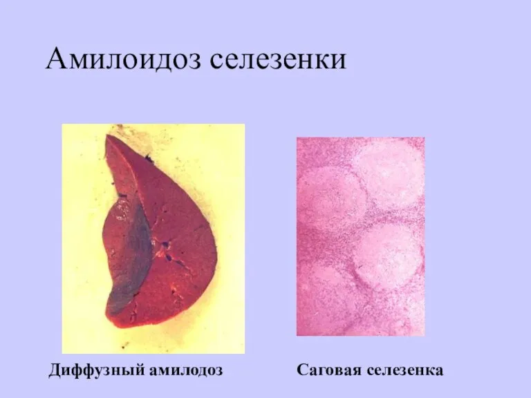 Амилоидоз селезенки Диффузный амилодоз Саговая селезенка