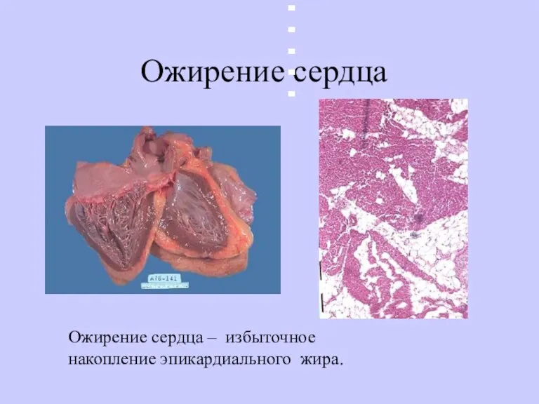 Ожирение сердца Date:5/17/2004 Ожирение сердца – избыточное накопление эпикардиального жира.