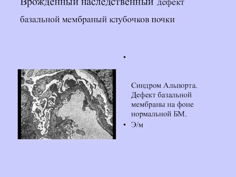 Врожденный наследственный дефект базальной мембраный клубочков почки Defective basement membrane