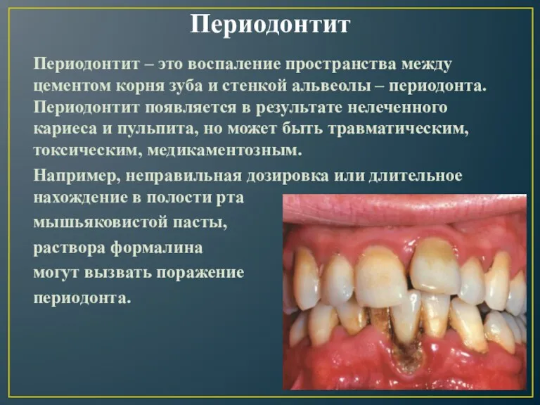 Периодонтит Периодонтит – это воспаление пространства между цементом корня зуба