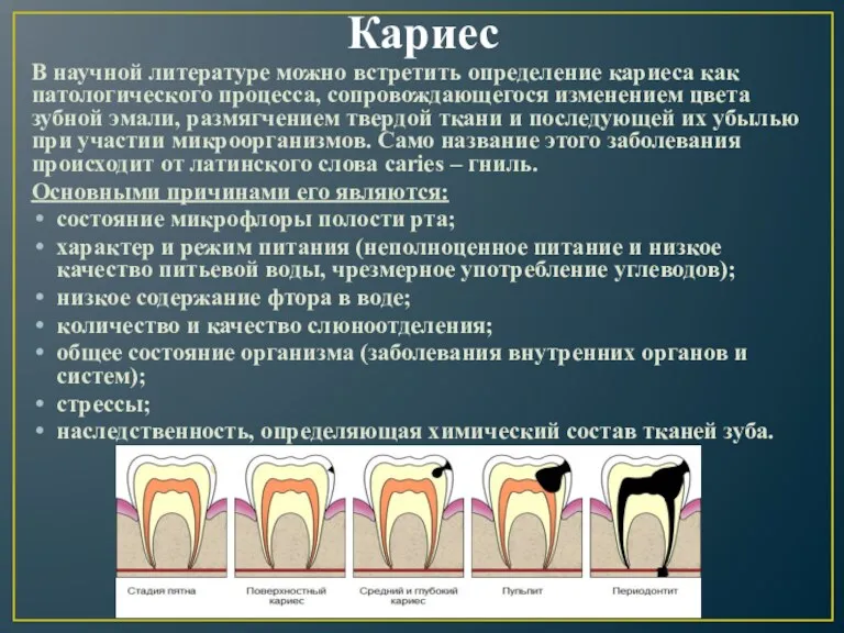 Кариес В научной литературе можно встретить определение кариеса как патологического