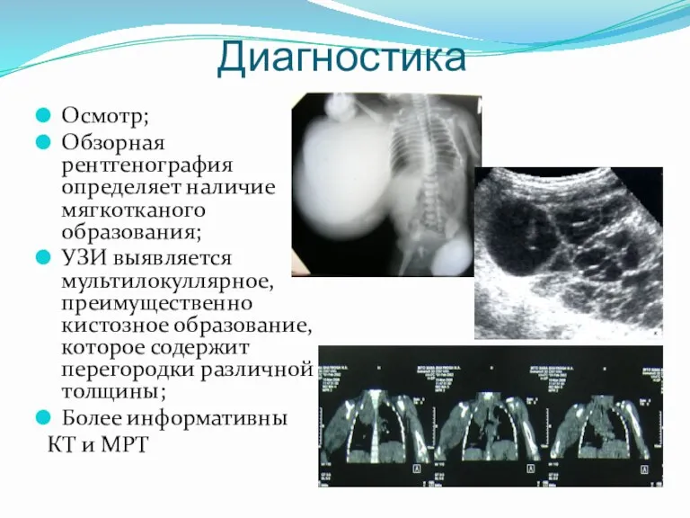 Диагностика Осмотр; Обзорная рентгенография определяет наличие мягкотканого образования; УЗИ выявляется