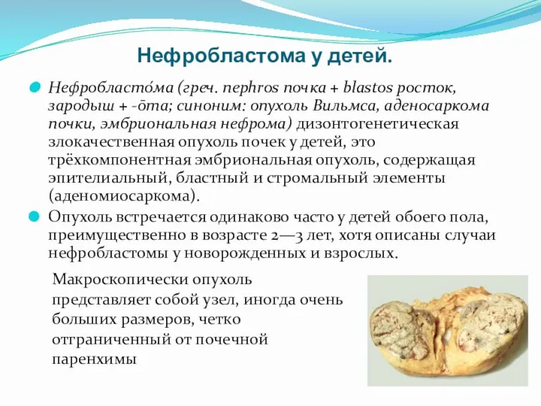 Нефробластома у детей. Нефробласто́ма (греч. nephros почка + blastos росток,