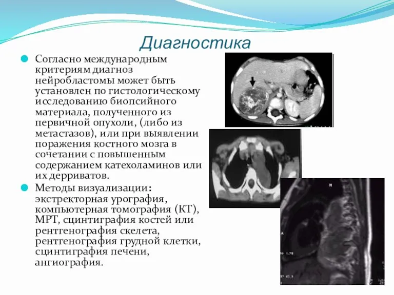 Диагностика Согласно международным критериям диагноз нейробластомы может быть установлен по