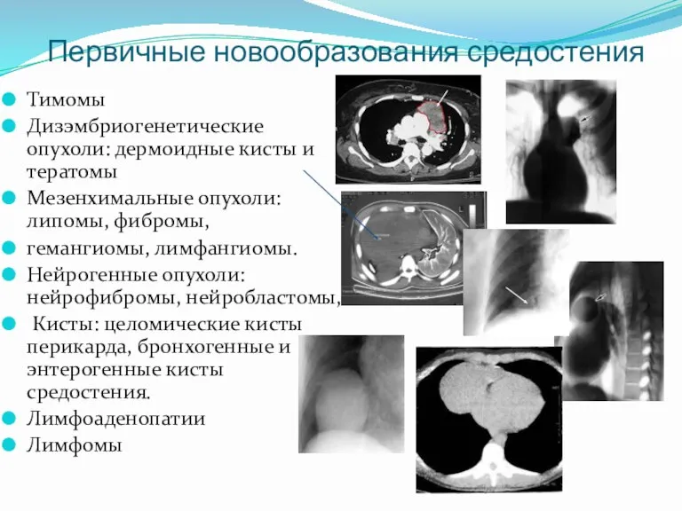 Первичные новообразования средостения Тимомы Дизэмбриогенетические опухоли: дермоидные кисты и тератомы