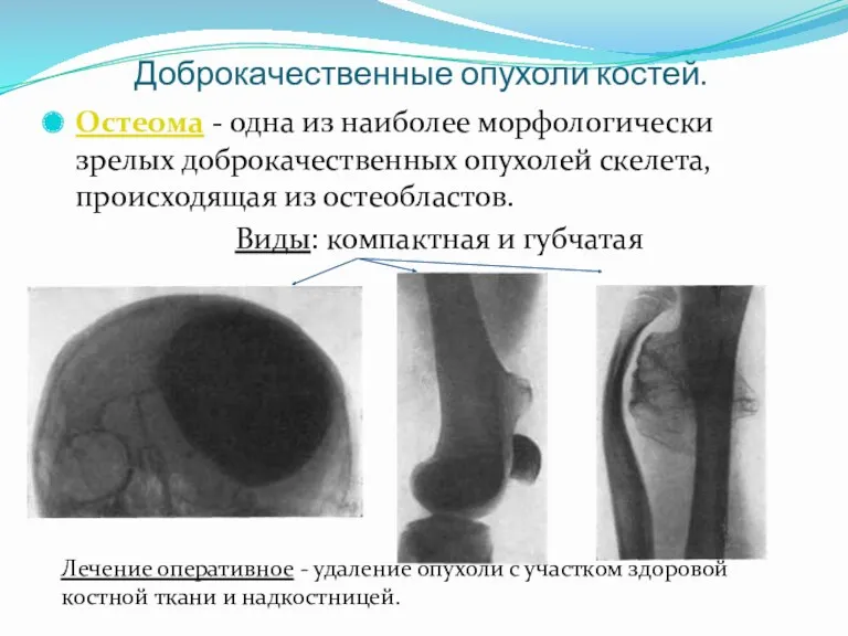 Доброкачественные опухоли костей. Остеома - одна из наиболее морфологически зрелых