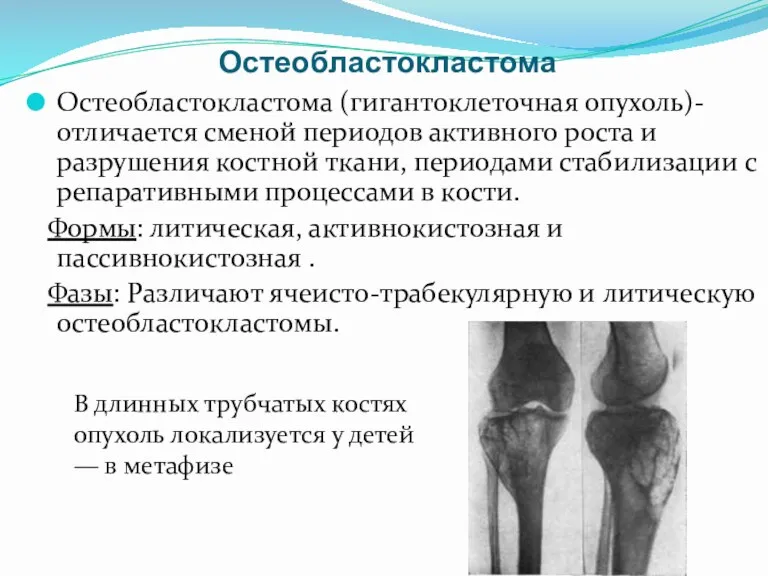 Остеобластокластома Остеобластокластома (гигантоклеточная опухоль)- отличается сменой периодов активного роста и