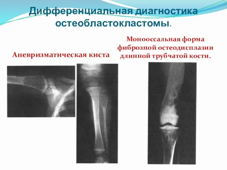 Дифференциальная диагностика остеобластокластомы. Аневризматическая киста Монооссальная форма фиброзной остеодисплазии длинной трубчатой кости.