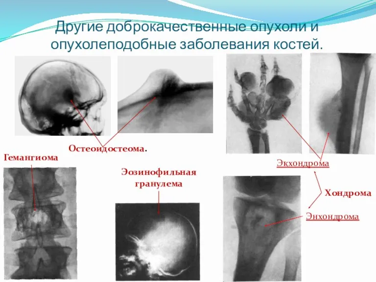 Другие доброкачественные опухоли и опухолеподобные заболевания костей. Остеоидостеома. Хондрома Энхондрома Экхондрома Гемангиома Эозинофильная гранулема