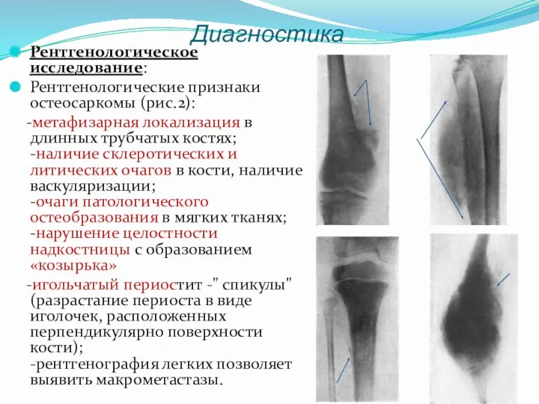 Диагностика Рентгенологическое исследование: Рентгенологические признаки остеосаркомы (рис.2): -метафизарная локализация в