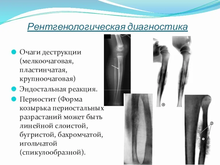 Рентгенологическая диагностика Очаги деструкции (мелкоочаговая, пластинчатая, крупноочаговая) Эндостальная реакция. Периостит